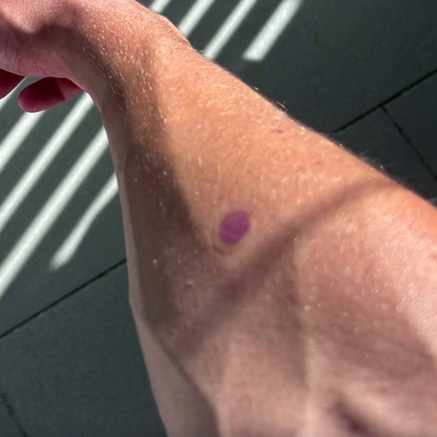 Tester photo: the same patch deep purple with no suncream over the top.